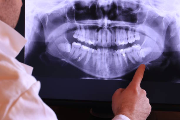 Best Emergency Wisdom Tooth Extraction in Falls Church, VA